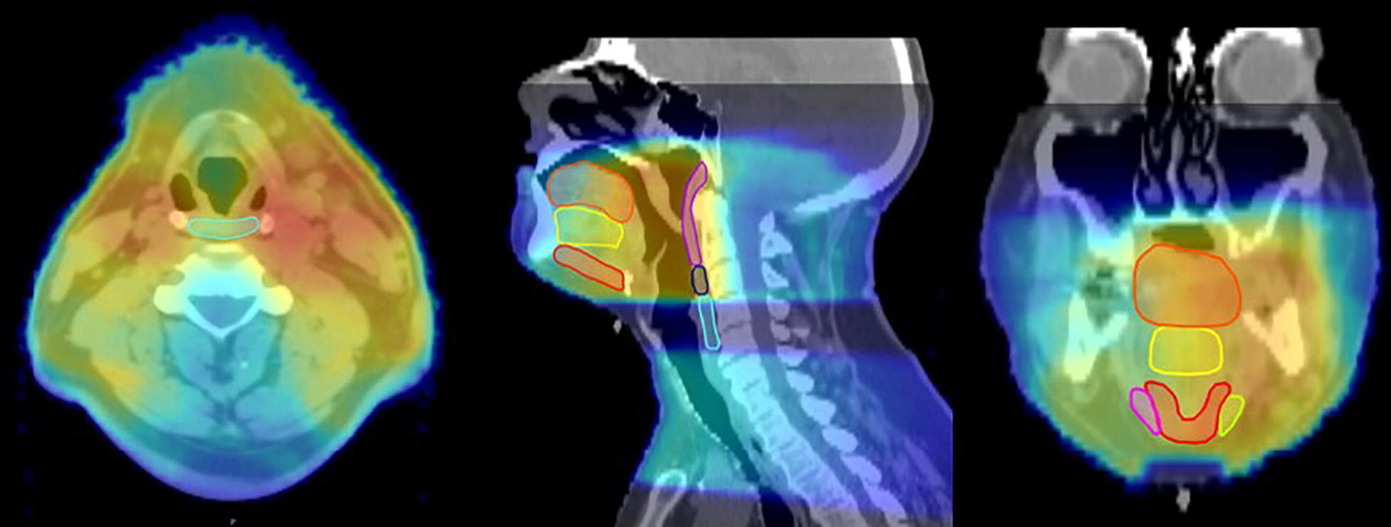 Chronic Radiation-Associated Dysphagia in Oropharyngeal Cancer Survivors: Towards Age-Adjusted Dose Constraints for Deglutitive Muscles
