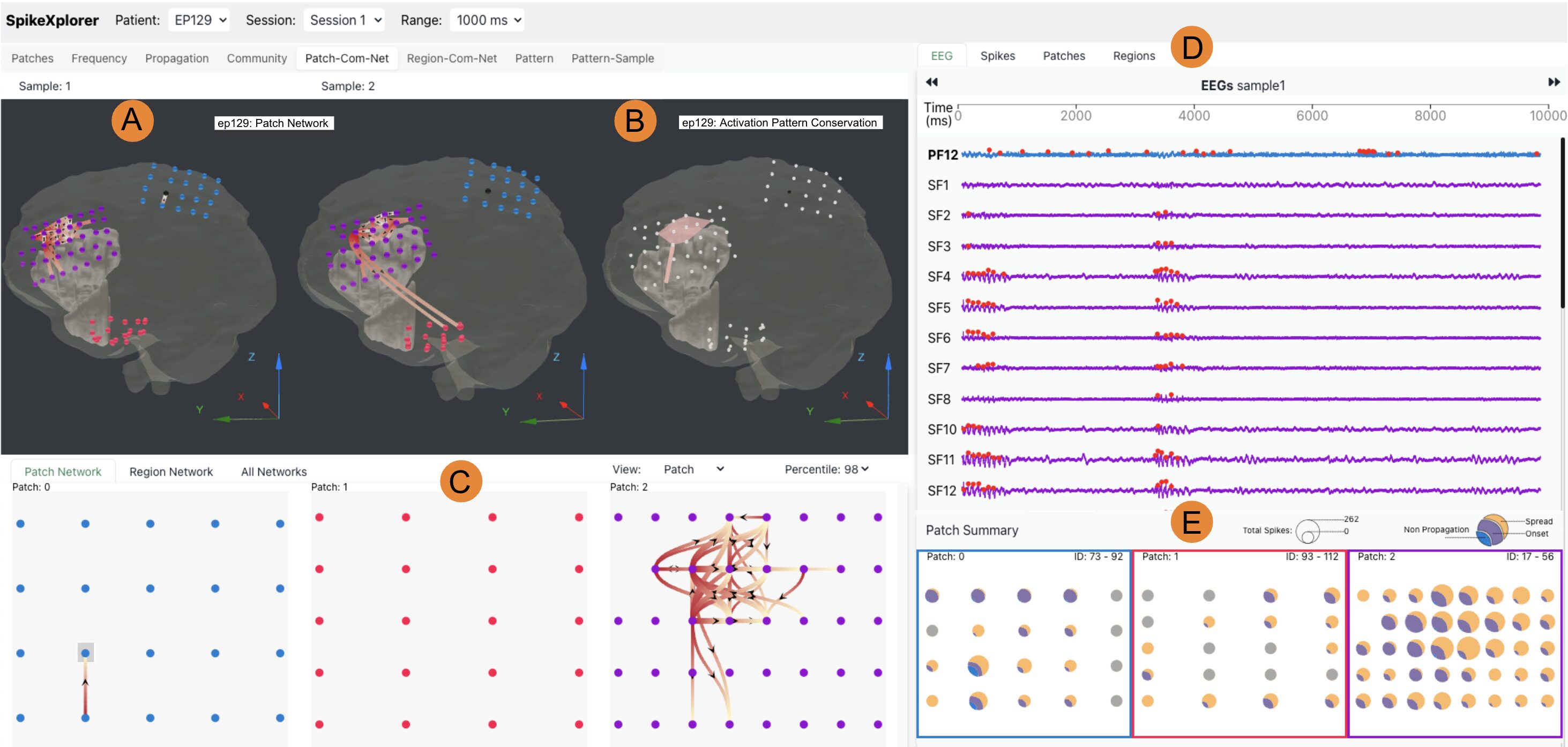 Neurosurgery Network Pattern Analysis with 2nd Generation Ensembles